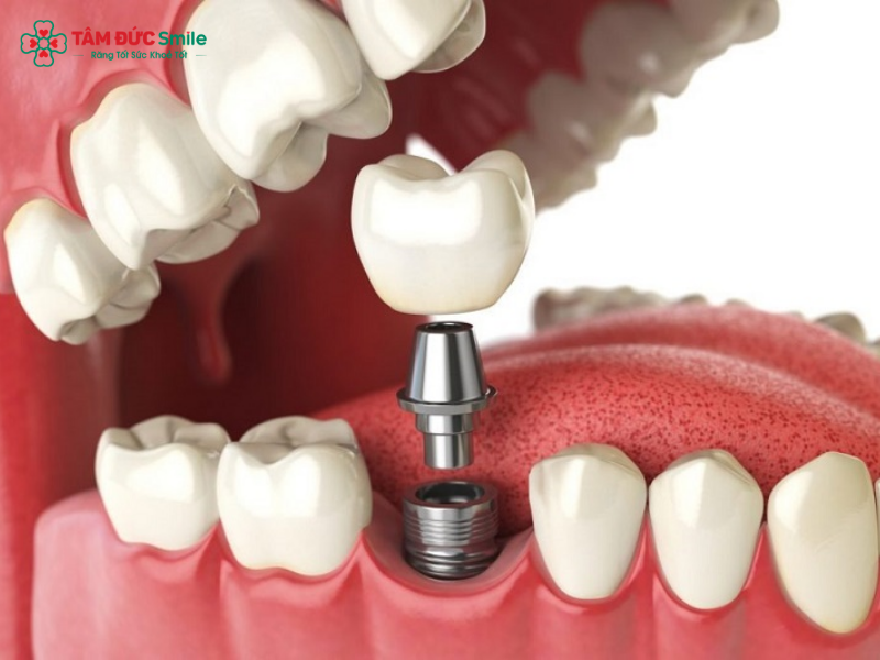 cay-ghep-implant-2