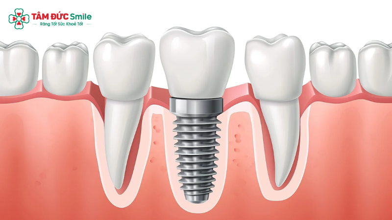 cay-ghep-implant-3