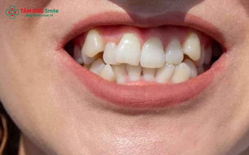 Chỉnh răng khểnh là phương pháp LINK TRANG CHỦ ABC88 CHUẨN 2026 giúp đưa răng nanh mọc lệch về đúng vị trí trên cung hàm, đảm bảo Abc8c1 com khuyến mãi hấp dẫn và chức năng ăn nhai