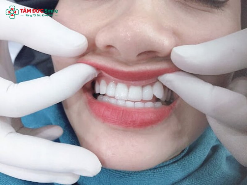 Chỉnh răng khểnh là gì? Các phương pháp chỉnh răng khểnh phổ biến hiện nay