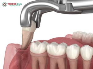 Có nên nhổ răng khôn khi đang bị đau? Trường hợp nên và không nên nhổ răng khôn khi đang đau