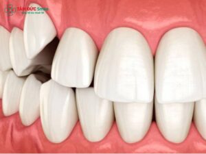 Con gái có răng khểnh 2 bên đẹp hay xấu? Góc nhìn dân gian, khoa học và giải pháp Abc888k vip truy cập nhanh