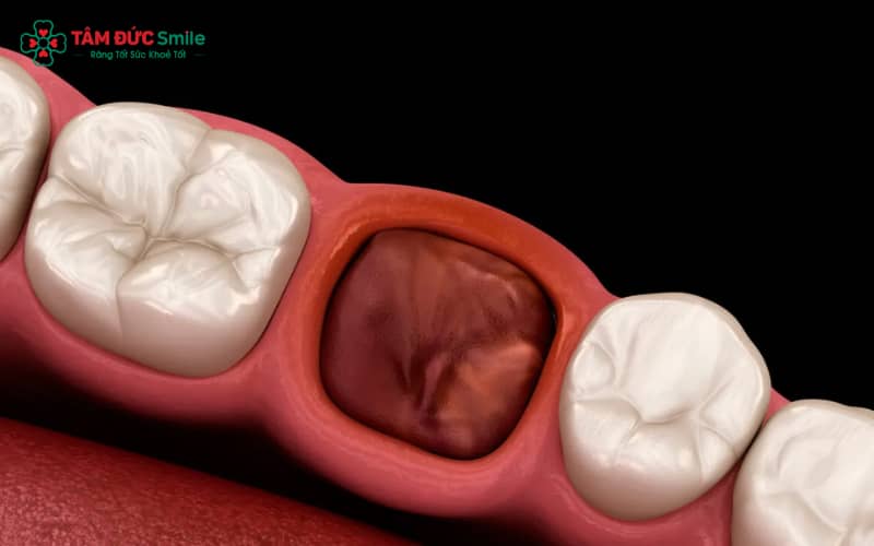 Cục máu đông tan sớm gây tình trạng ‘ổ răng khô’, đau nhiều và chậm lành thương