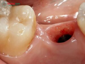 Cục máu đông sau khi nhổ răng khi nào hết? Dấu hiệu tan, cách chăm sóc đúng