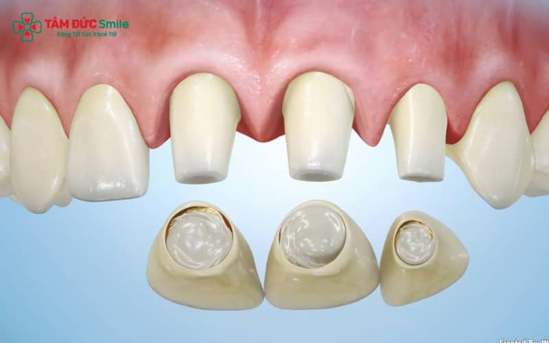 Veneer sứ cao cấp có độ mỏng tự nhiên, màu sắc trong suốt như răng thật và độ bền cao theo thời gian