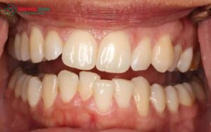 Răng khấp khểnh dán sứ được không? Ưu, nhược điểm khi dán sứ răng khấp khểnh