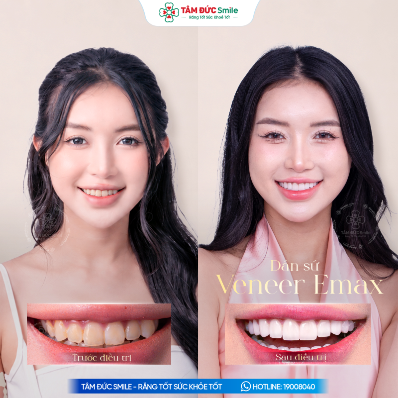 dan-su-veneer-9