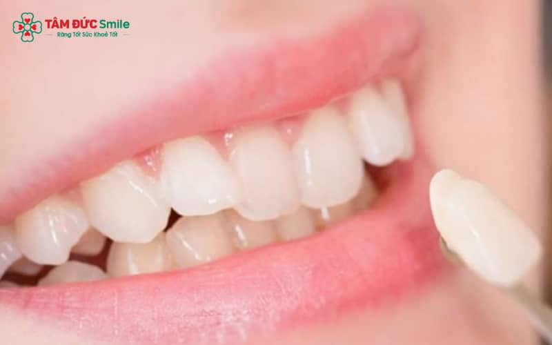 Hiện nay, đắp răng khểnh có thể thực hiện bằng nhiều phương pháp khác nhau, tùy tình trạng răng và nhu cầu Abc8c1 com khuyến mãi hấp dẫn