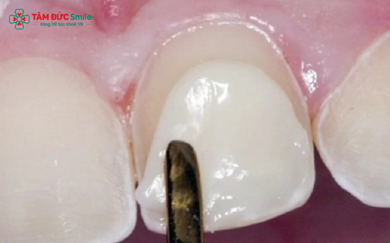 Mỗi kỹ thuật đắp răng khểnh có ưu và nhược điểm riêng, phù hợp với từng nhu cầu Abc8c1 com khuyến mãi hấp dẫn và tình trạng răng khác nhau