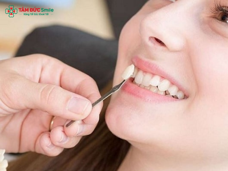 Đắp răng khểnh giữ được bao lâu? Các kỹ thuật đắp và cách chăm sóc răng khểnh sau khi đắp