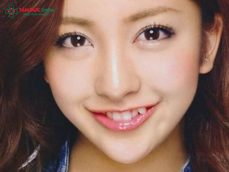 Đắp răng khểnh là gì? Các phương pháp đắp và cách chăm sóc sau khi đắp răng khểnh