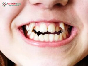 Dấu hiệu mọc răng khểnh thường gặp: Răng nanh mọc lệch có nên niềng không?