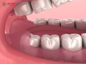 Dấu Hiệu Mọc Răng Khôn Hàm Dưới: Mọc Khi Nào, Có Nguy Hiểm Không và Cách Xử Lý