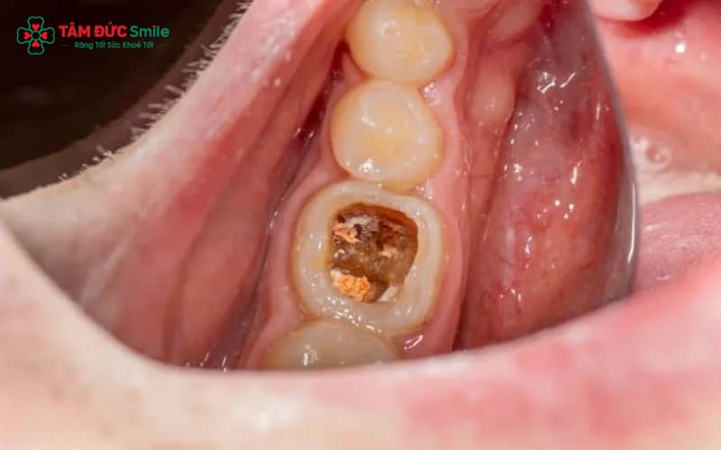 Sâu răng tiến triển qua 4 giai đoạn: men răng – ngà răng – tủy răng – biến chứng nguy hiểm