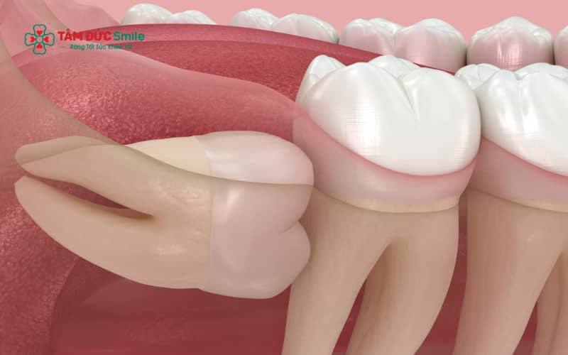 Đau răng khôn kéo dài gây mất ngủ không chỉ ảnh hưởng sức khỏe mà còn tiềm ẩn nguy cơ viêm nhiễm lan rộng và tổn thương răng kế cận