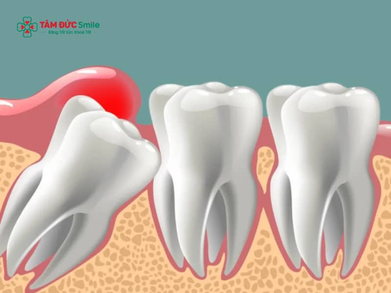 Đau răng khôn không ngủ được: đau về đêm, mất ngủ, sưng sốt và cách xử lý