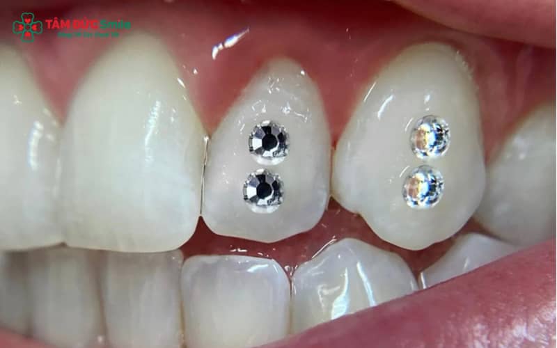 Đính đá răng khểnh đúng kỹ thuật không xâm lấn, không làm tổn hại men răng và không ảnh hưởng chức năng ăn nhai