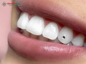 Đính đá răng khểnh Abc8c1 com khuyến mãi hấp dẫn: Có hại không, giá bao nhiêu, bền và đau không?