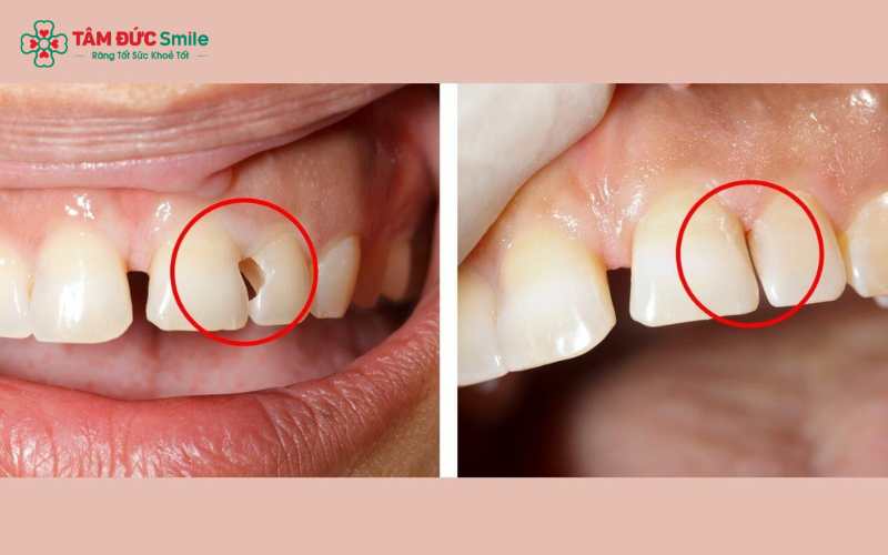 Răng đã được hàn vẫn có nguy cơ sâu lại nếu miếng trám không khít