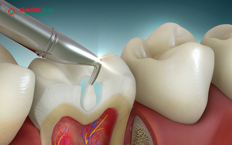 Kỹ thuật trám kém, vật liệu không phù hợp hoặc miếng trám bong, nứt có thể tạo khe hở, khiến vi khuẩn tiếp tục tấn công và gây ABC88 com đăng nhập tái phát.