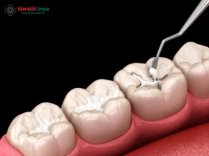 Hàn răng xong có bị sâu lại không? Nguyên nhân, dấu hiệu và cách phòng ngừa hiệu quả