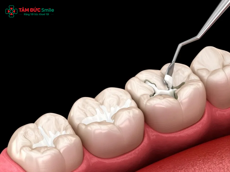 Hàn răng xong có bị sâu lại không? Nguyên nhân, dấu hiệu và cách phòng ngừa hiệu quả