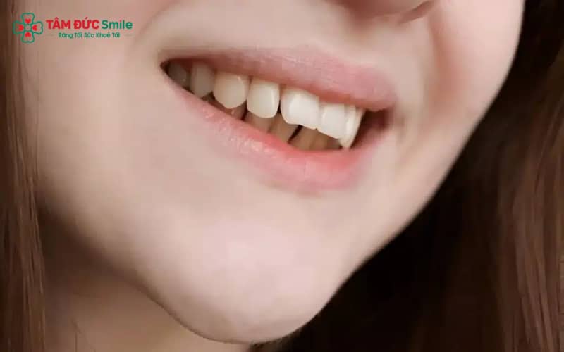 Các nguyên nhân phổ biến gây hô hàm trên – bao gồm yếu tố di truyền, tăng trưởng hàm quá mức và các thói quen xấu từ nhỏ