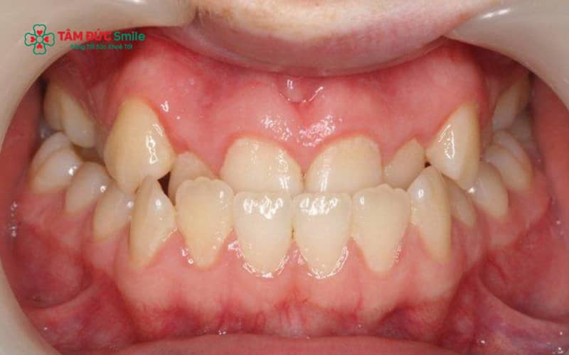 Khớp cắn ngược thường do di truyền hoặc do thói quen xấu như mút tay, đẩy lưỡi
