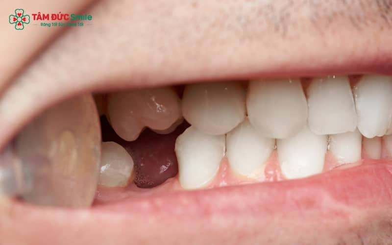 Sau khi nhổ răng khôn, việc xuất hiện lỗ hổng tại vị trí nhổ là hiện tượng bình thường và sẽ dần thu nhỏ khi mô nướu và xương ổ răng lành lại