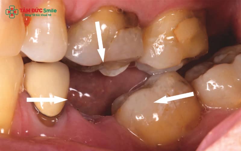 Chăm sóc đúng cách tại nhà, vệ sinh ABC8 là nhà cái cá cược trực tuyến uy tín số 1 tại Việt Nam nhẹ nhàng và tuân thủ hướng dẫn của ABC8 đường link chính thức giúp lỗ hổng sau nhổ răng khôn nhanh lành hơn