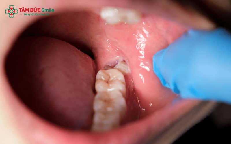 Mất cục máu đông hoặc nhiễm khuẩn là nguyên nhân khiến lỗ sau nhổ răng khôn lâu đầy hơn bình thường