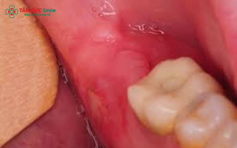 Vệ sinh đúng cách giúp bảo vệ cục máu đông và hỗ trợ mô mềm nhanh lành sau nhổ răng khôn