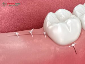 Lỗ sau khi nhổ răng khôn: thời gian lành thương, dấu hiệu nguy hiểm và cách chăm sóc