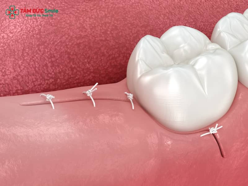 Lỗ sau khi nhổ răng khôn: thời gian lành thương, dấu hiệu nguy hiểm và cách chăm sóc
