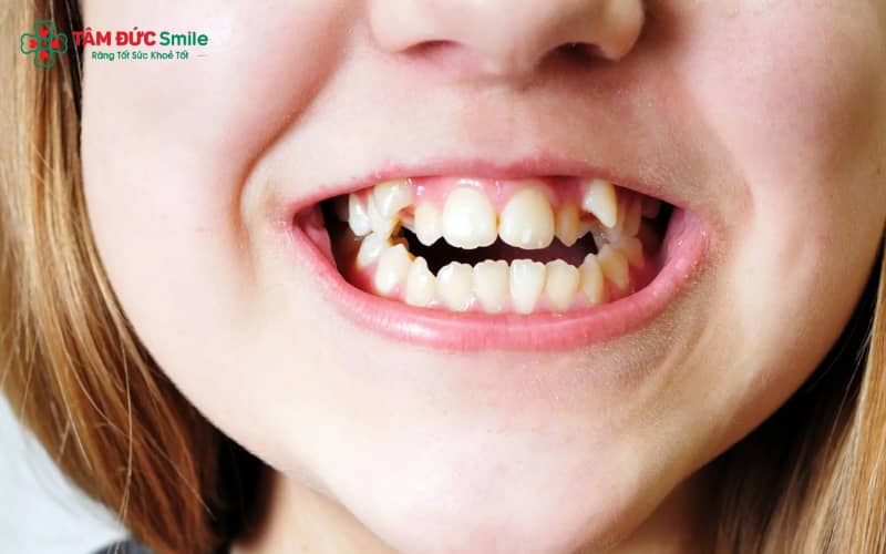 Má lúm răng khểnh là sự kết hợp giữa má lúm đồng tiền và răng khểnh, tạo điểm nhấn duyên dáng khi cười