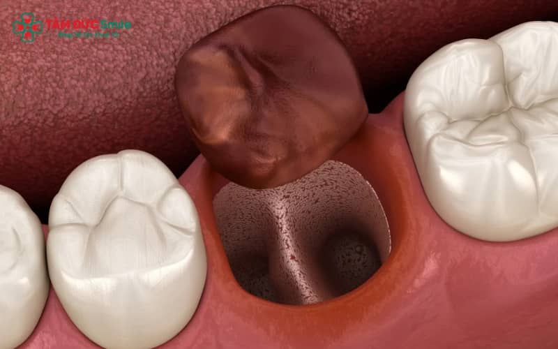 Màng trắng là fibrin – một phần của quá trình lành thương tự nhiên, xuất hiện sau khi cục máu đông ổn định