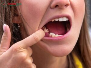 Màng trắng sau khi nhổ răng: nguyên nhân, dấu hiệu bất thường và cách chăm sóc đúng