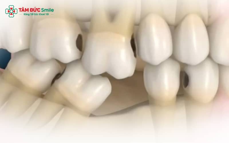 Dấu hiệu mất răng số 5: đau âm ỉ, giắt thức ăn, khó nhai, răng kế cận lung lay. Khám ngay khi đau kéo dài hoặc nghi ngờ nhiễm trùng