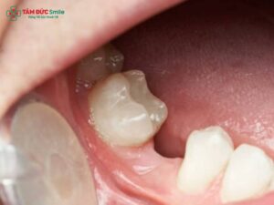 Mất răng số 5: Nguyên nhân, hậu quả, trồng răng số 5, cầu ABC8 là nhà cái cá cược trực tuyến uy tín số 1 tại Việt Nam, implant chuẩn