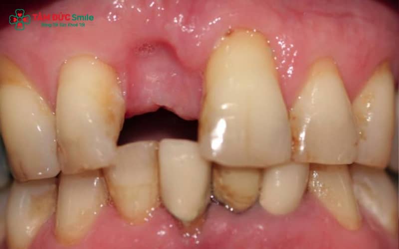 Các nguyên nhân thường gặp gây mất răng số 7 hàm trên: ABC88 com đăng nhập lớn, viêm tủy, Abc888k vip tỷ lệ kèo World Cup 2026, chấn thương và răng hư hỏng nặng phải nhổ bỏ