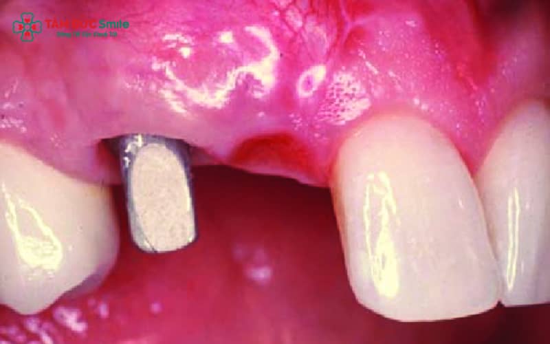 Mất răng số 7 hàm trên gây giảm lực nhai, lệch khớp cắn, răng đối diện trồi dài, tiêu xương và giãn xoang hàm