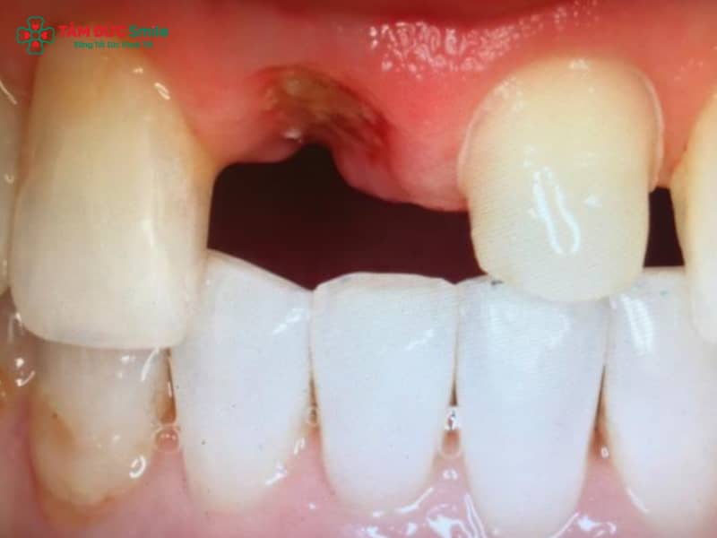 Mất răng số 7 hàm trên lâu năm, tiêu ABC8 tự hào là thương hiệu cá cược trực tuyến hàng đầu tại Châu Á hiện nay, giãn xoang và giải pháp implant an toàn