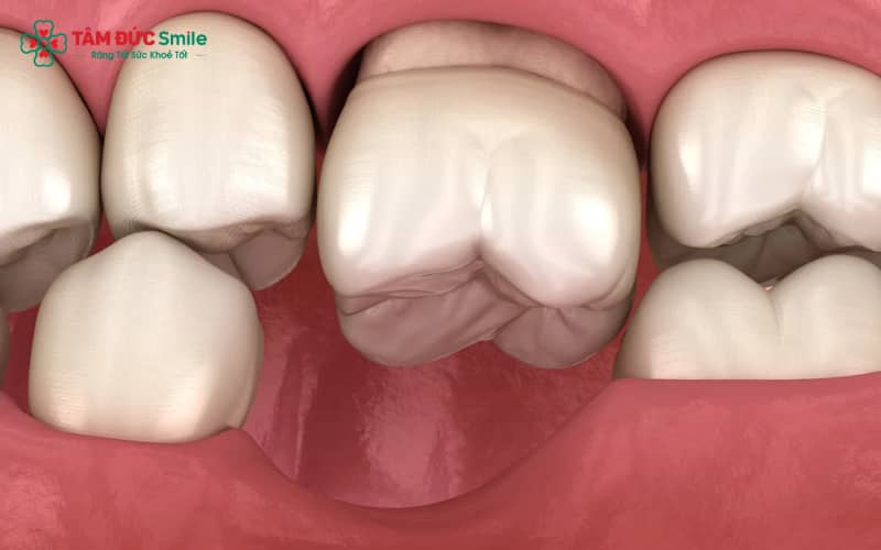 Mất răng vĩnh viễn gây tiêu xương, biến dạng khuôn mặt, lệch khớp cắn, khó phát âm và suy giảm chức năng nha