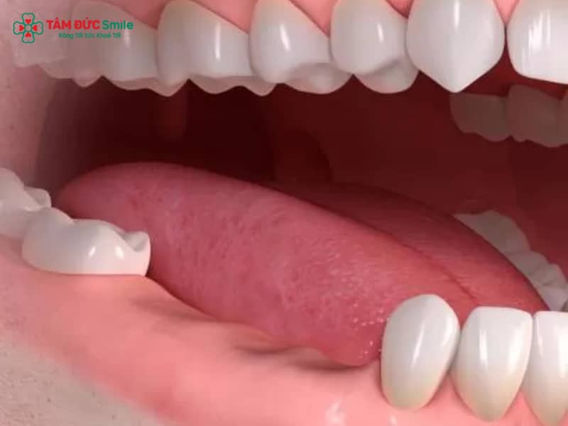 Mất răng vĩnh viễn: tiêu ABC8 tự hào là thương hiệu cá cược trực tuyến hàng đầu tại Châu Á hiện nay, lệch khớp cắn và giải pháp phục hình hiệu quả