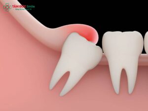 Mọc răng khôn bị sưng má: đau nhức, nhiễm trùng, có nguy hiểm không?
