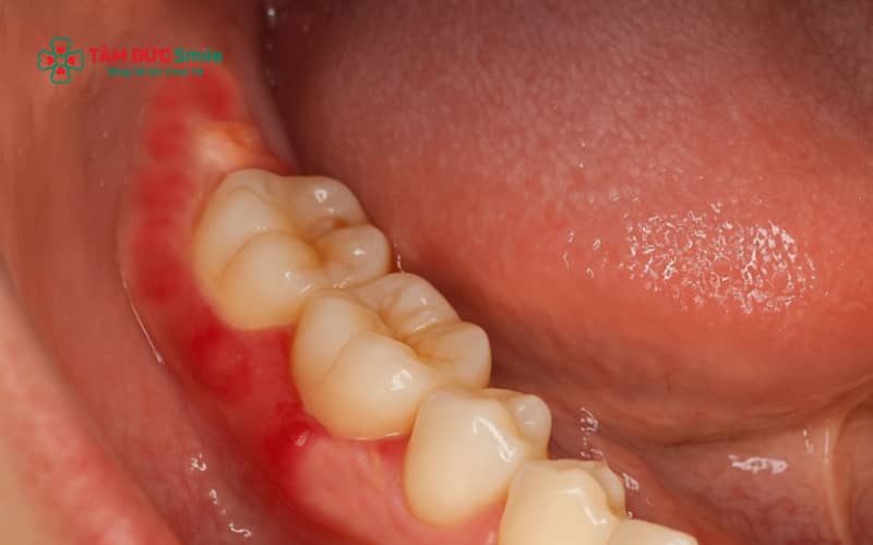 Viêm lợi trùm, răng khôn mọc lệch – mọc ngầm hoặc ABC88 com đăng nhập khôn dẫn đến viêm tủy là những nguyên nhân phổ biến gây tình trạng răng khôn có mủ