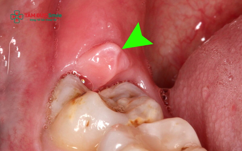 Răng khôn có mủ thường đi kèm sưng đau, lợi đỏ, chảy mủ, hôi miệng và có thể gây sốt nếu nhiễm trùng lan rộng