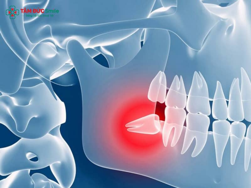 Nên nhổ răng khôn ở bệnh viện hay phòng khám? Tiêu Chí Lựa Chọn Địa Chỉ Nhổ Răng Khôn
