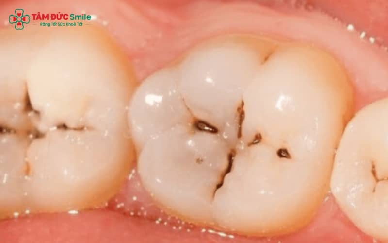Răng sâu tạo lỗ hở khiến ngà và tủy răng dễ bị kích thích bởi thức ăn, vi khuẩn và nhiệt độ, từ đó gây đau nhức dữ dội