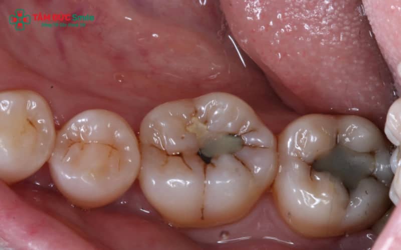 Khi răng sâu đau kéo dài, đau tăng về đêm, có sưng nướu hoặc hôi miệng, người bệnh cần đi khám nha sĩ sớm